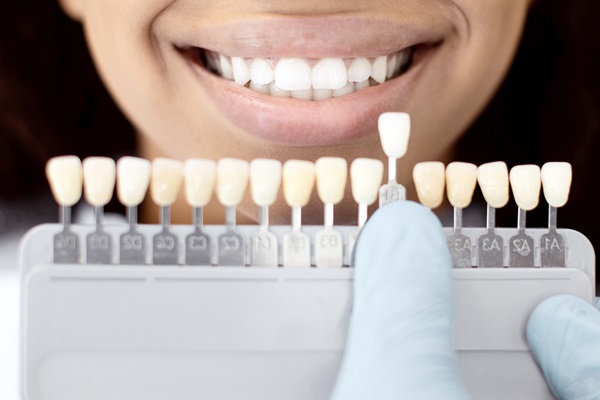 Everything You Need To Know About Dental Veneers