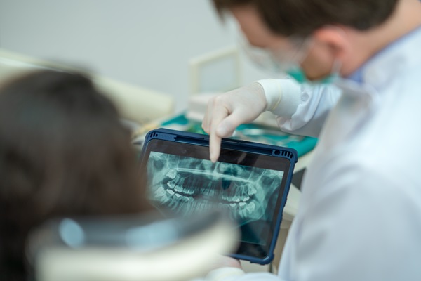 Debunking Root Canal Myths: How This Procedure Protects Oral Health